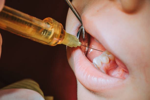 Tooth extractions at Ewing Dental Group in Ewing NJ